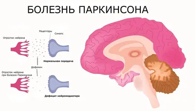 Болезнь Паркинсона: признаки, причины, диагностика и лечение | МРТ Эксперт