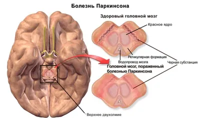 Передается ли болезнь Паркинсона по наследству.