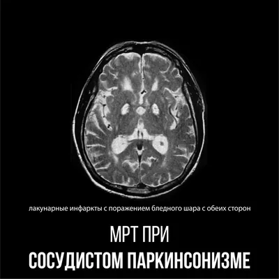 Болезнь Паркинсона или синдром Паркинсонизма? Есть ли разница? Что лучше? |  Пикабу