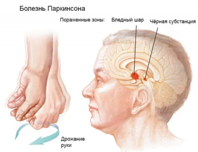 Болезнь Паркинсона: что это, симптомы, причины, диагностика, лечение