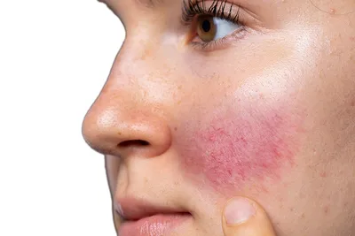 Самые распространенные заболевания кожи лица