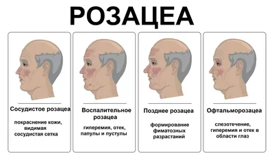 Себорея: как лечить себорею на голове