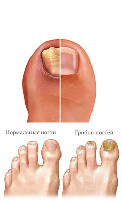 Онихолизис: причины, диагностика и лечение отслоения ногтя в Москве