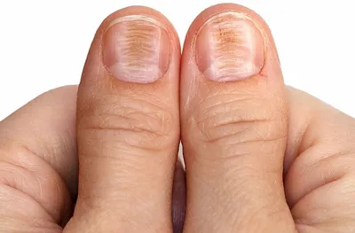Маникюр. Строение ногтя. Факторы торможения роста ногтей. Болезни ногтей.  Виды маникюра - презентация онлайн