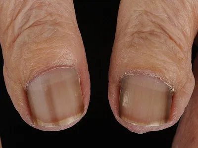 Болезни и лечение ногтей эффективно в домашних условиях