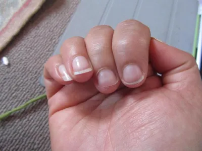 Какие болезни могут быть причиной некрасивых ногтей — 