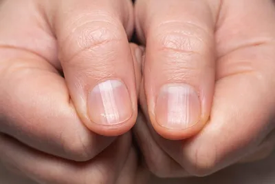 Как определить болезнь по ногтям? Ногти скажут всё о вашем здоровье! |  Школа Векторного Массажа и Соматики | Дзен