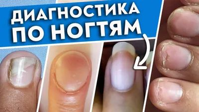 Pin by Ирина Ирина on болезни ногтей и кожи | The 100