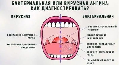 Болит горло после удаления зуба мудрости - почему, сколько, что делать