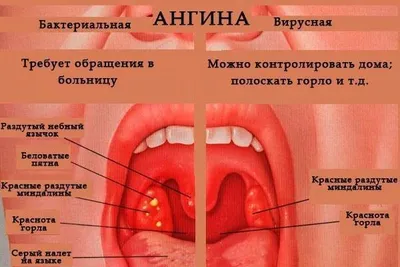 Больное горло пытает несколько лет. Прощу помощи | Пикабу