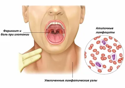 Болит ли горло при коронавирус?