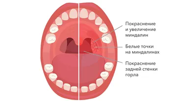 Болит горло после удаления зуба мудрости: что делать?