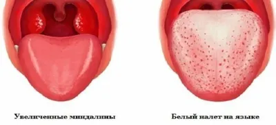 Болит горло и нет голоса: что делать? | Клиника «Гармония»