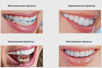 Брекеты - "Народная стоматология"