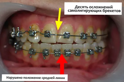 Установка брекетов в Минске, брекеты на зубы цена стоимость