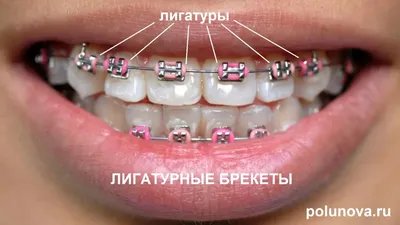Как правильно чистить зубы с брекетам и щеткой? - энциклопедия 