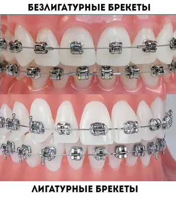 Металлические брекеты в Москве – цены, отзывы на установку в  стоматологических клиниках Зуб.ру