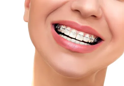 Как брекеты выравнивают зубы - Cтоматология Май