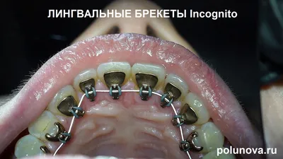 Брекеты на зубы Шымкент цена | Стоимость установки брекетов