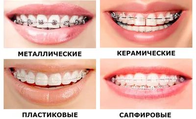 Мифы о брекетах и коррекции прикуса: больно ли, кому подходят, расшатывают  ли зубы