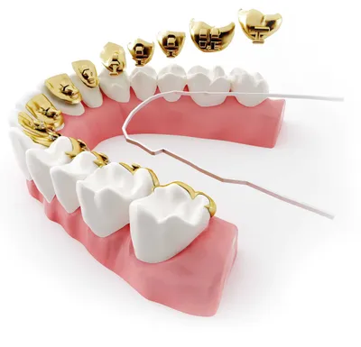 Брекеты Харьков Цена - Акция металлические, керамические брекеты