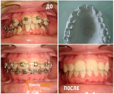 Сколько стоят брекеты - поставить брекеты в Москве: цена