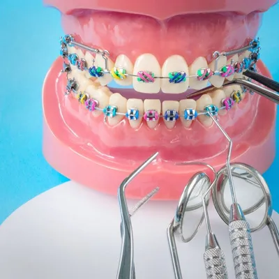 Какие брекеты лучше ставить взрослому: подбор эффективной брекет-системы у  ортодонта, отличия и особенности