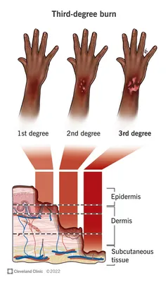 Identifying a Severe Burn - Elite Medical Center