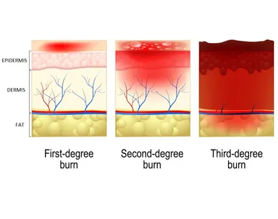Second-degree burn: Causes, symptoms, and treatment