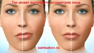 Подтяжка верхней трети лица - цены на эндоскопический лифтинг верхней части  лица в СПб
