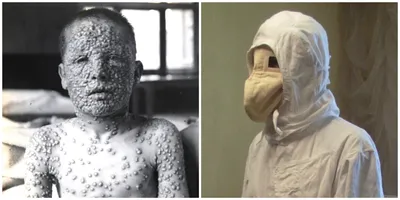 20 ужасающих фото из истории натуральной оспы