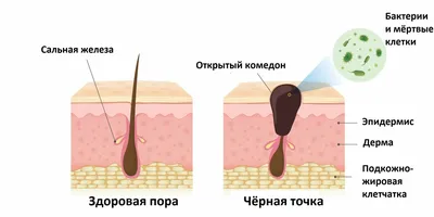 Черные точки на лице, откуда же они берутся и что с ними делать? | Блог  BEAUTIME