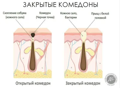 Избавится от черных точек на лице в салоне или самостоятельно дома -  Идеал-Лик