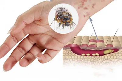Чесотка: инкубационный период, лечение и профилактика