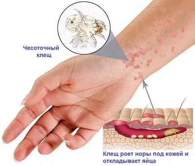 Чесотка - признаки, причины, симптомы, лечение и профилактика - 