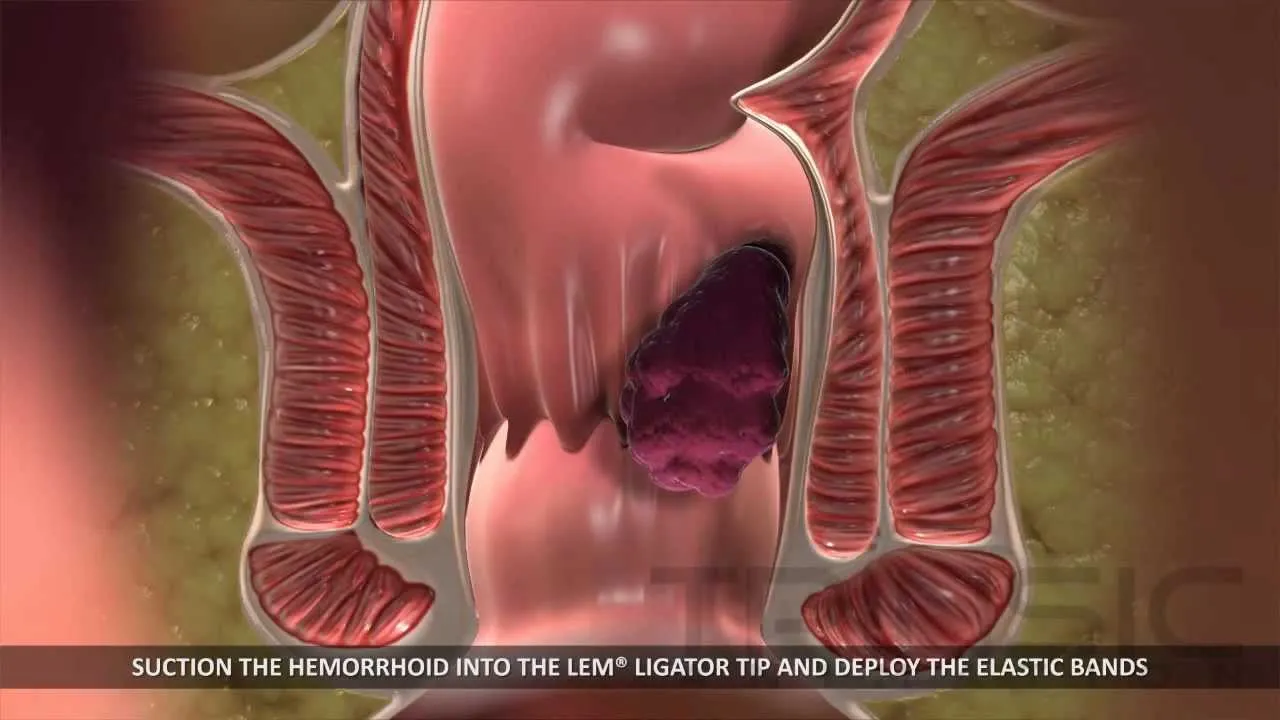 Геморрой лечение латексными. Внутренний геморрой картинки.
