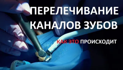 Перелечивание каналов зуба в ТОП 1 клинике Москвы - Немецкий  имплантологический центр
