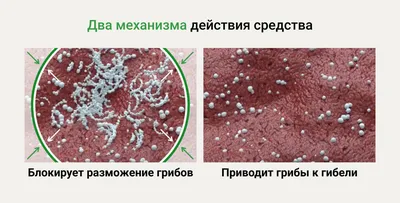 Молочница во рту (кандидоз) – у детей и взрослых, симптомы, причины, лечение