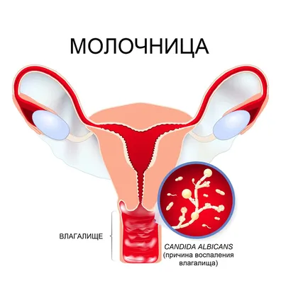 Молочница у беременных: симптомы, лечение в 1, 2 и 3 триместрах
