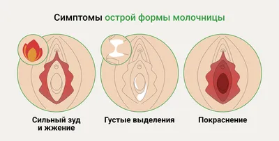 Молочница — диагностика и лечение вагинального кандидоза в Клиническом  госпитале на Яузе, Москва