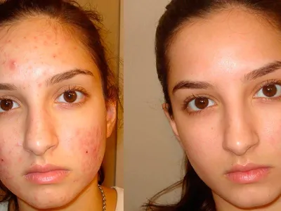 демодекс на лице | Natural acne remedies, Acne cure, Natural acne treatment