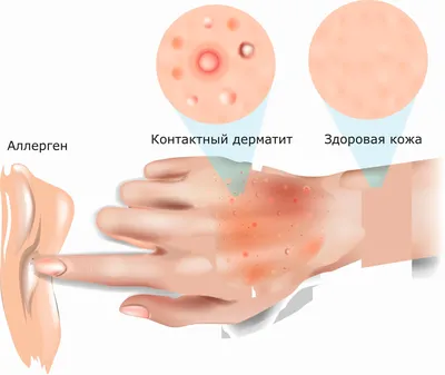 Актинический дерматит: причины, симптомы и лечение в Москве