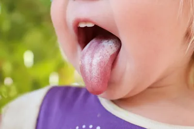 Врач-стоматолог рассказала – почему у ребенка меняется цвет языка,  образуются пятна и язвочки | О детском здоровье: с врачебного на  родительский | Дзен