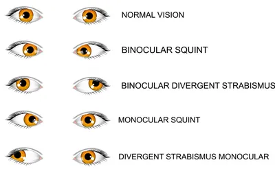 Исправление косоглазия у взрослых в Москве