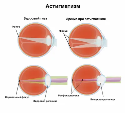 Расфокусировка зрения – что это такое, причины, диагностика, лечение