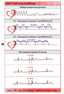 Абсолютно новая Шпора по ЭКГ | Медфорс