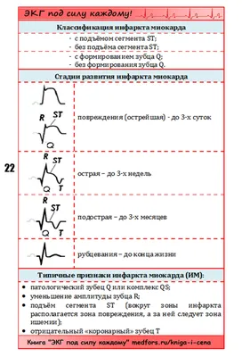 Абсолютно новая Шпора по ЭКГ | Медфорс