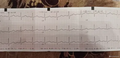Расшифровка ЭКГ | Консультация кардиолога детского в Минске на  -  ВРАЧИ БЕЛАРУСИ