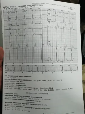 Ребята,помогите! Нужна расшифровка ЭКГ по фото | Пикабу
