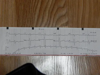 ЭКГ: что это такое, кому назначают и как расшифровать